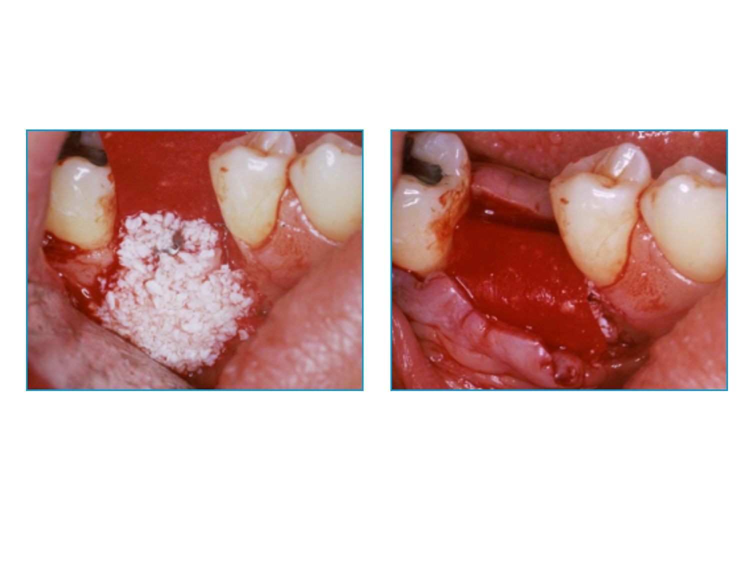 bioXEN Allograft