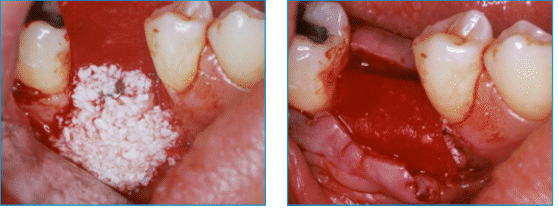 bioXEN Allograft